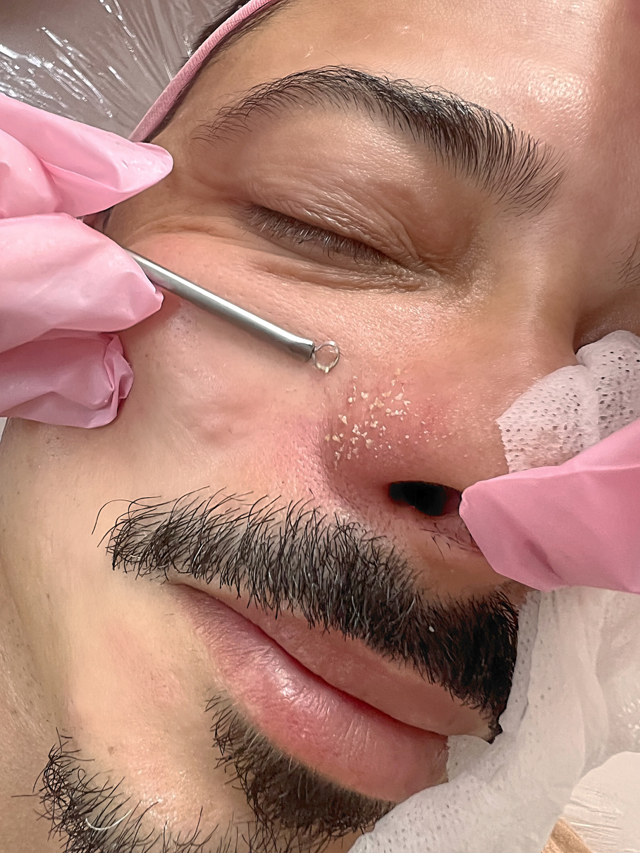 Resultado de Limpeza de pele na Rosa Beauty Space